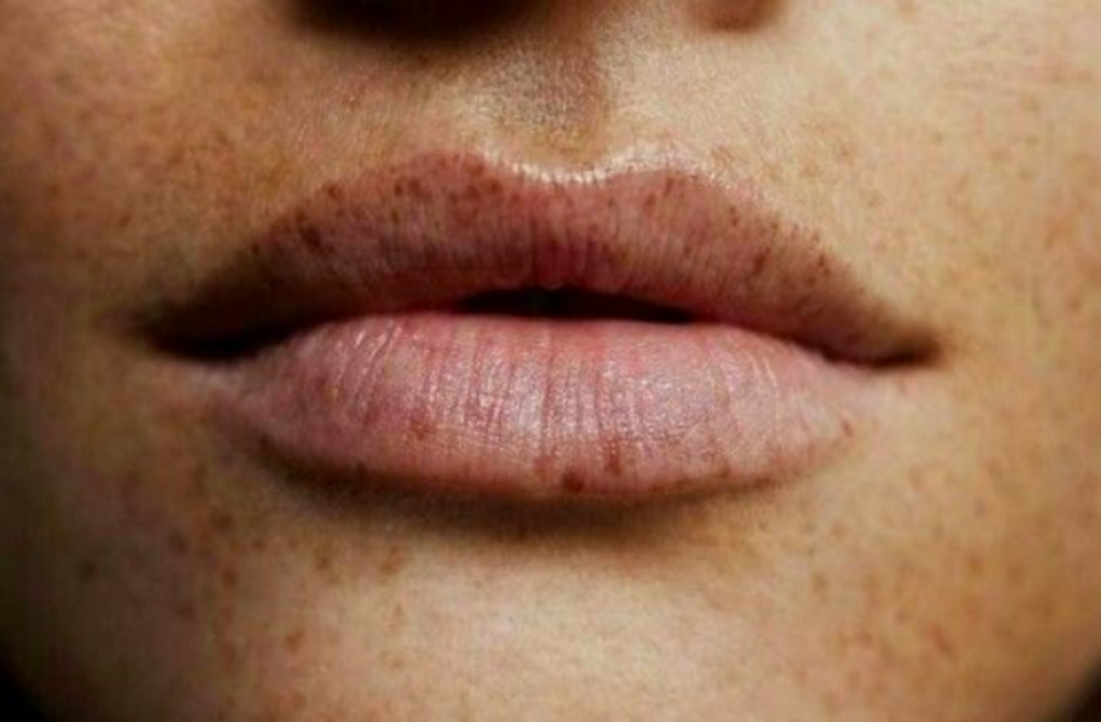 zomerproof lippen FEM FEM
