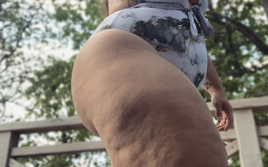 wat vinden mannen van cellulitis