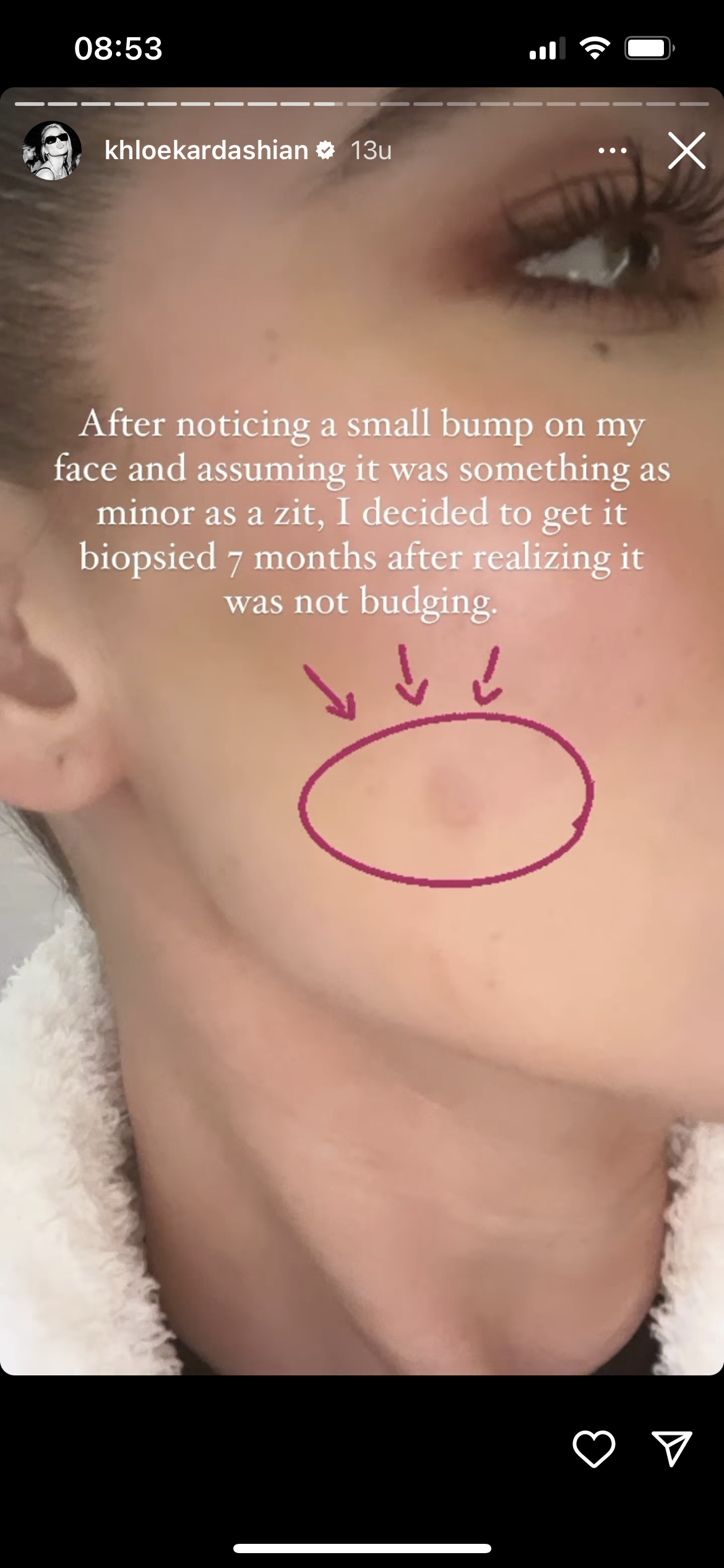 Khloe-Kardashian-tumor
