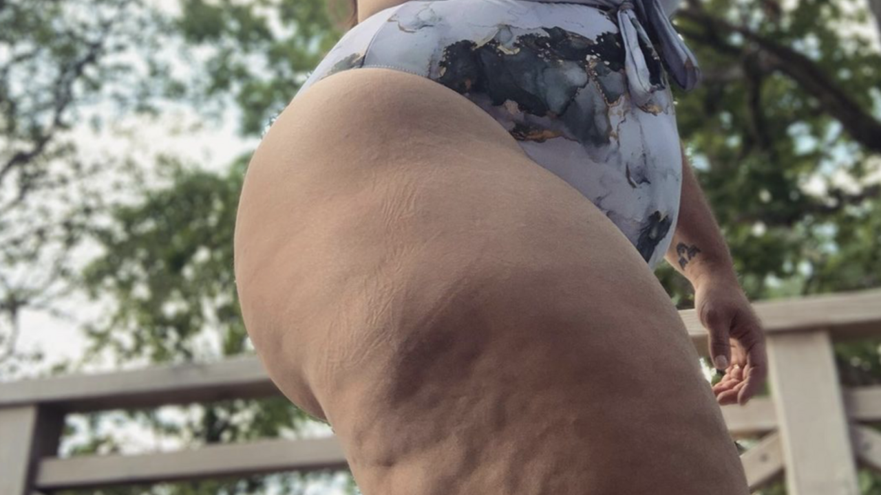 wat vinden mannen van cellulitis