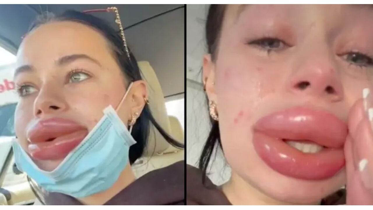 gratis lipfillers
