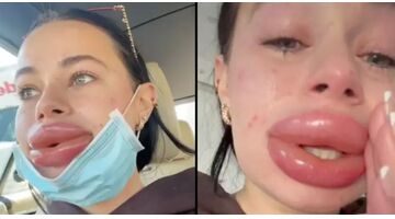 gratis lipfillers