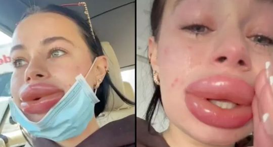 gratis lipfillers