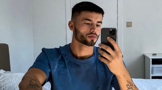 Love Island Lennert haartransplantatie