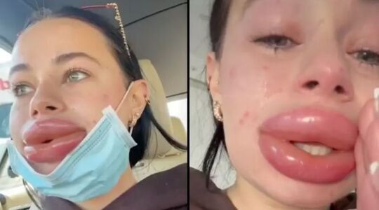 gratis lipfillers