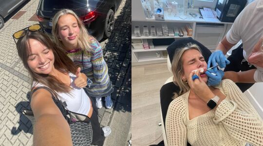 allergische reactie lipfillers tiktok