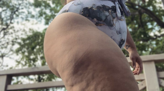 wat vinden mannen van cellulitis