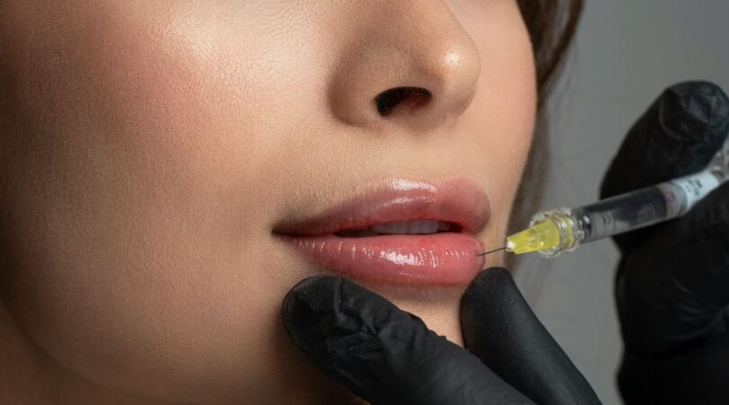 Vrouw krijgt lipfillers.